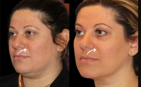 How to Choose the Best Plastic Surgeons in Dubai for Your First Sculptra Fillers