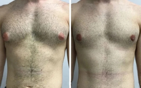 Are You a Candidate? Evaluation Tips from the Best Gynecomastia Surgeon in Dubai