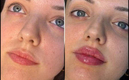 The Science Behind Fillers: Best Plastic Surgeon in Dubai Explains