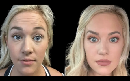 Why Botox Treatment in Dubai Is Gaining Popularity Among Millennials