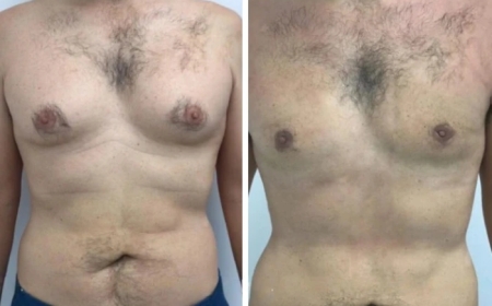 The Best Gynecomastia Surgeons in Dubai: Why Experience Matters
