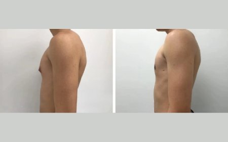 Best Time of Year to Get Gynecomastia Surgery in Dubai