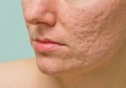 Clearer Skin Awaits: Acne Treatment Facial in Tysons Corner for Lasting Results